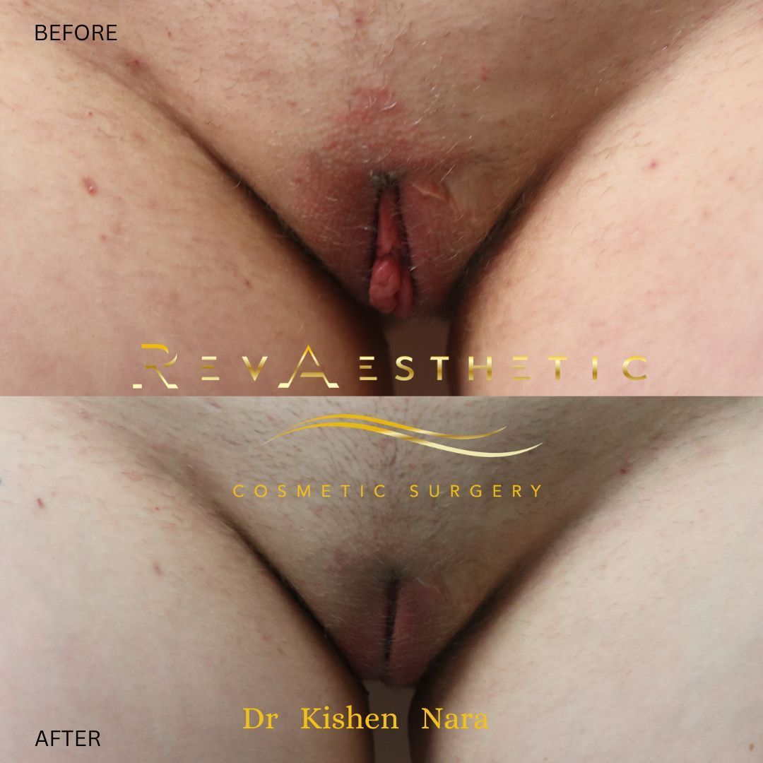 SAP labiaplasty — after